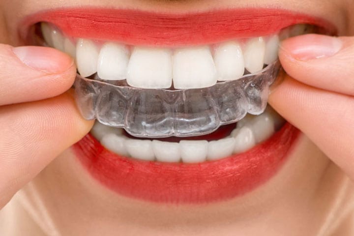 What are the Benefits of Wearing Invisalign?