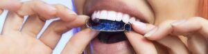 retention header image, blue retainers being fitted onto pearly white teeth